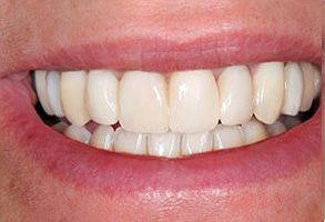 Emerald Smiles Dental | Sleep Apnea, Dental Fillings and Ceramic Crowns